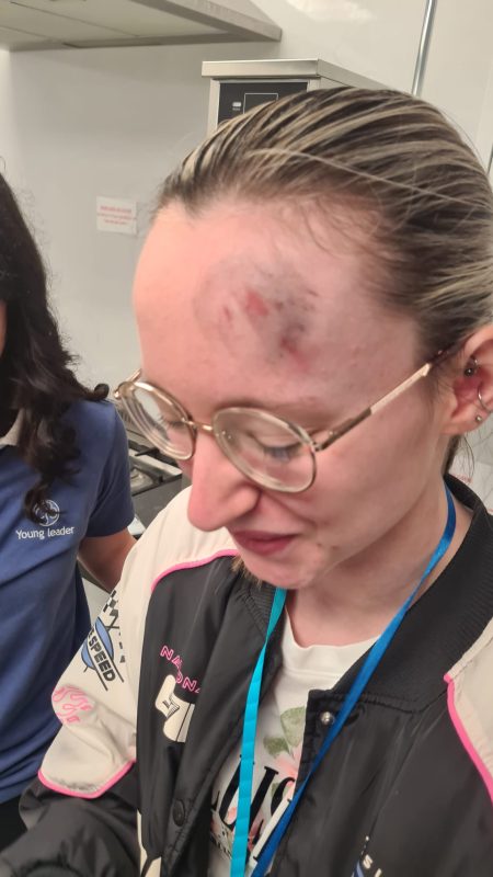 Teenager wearing glasses with a bruised and slightly bloodied forehead wound